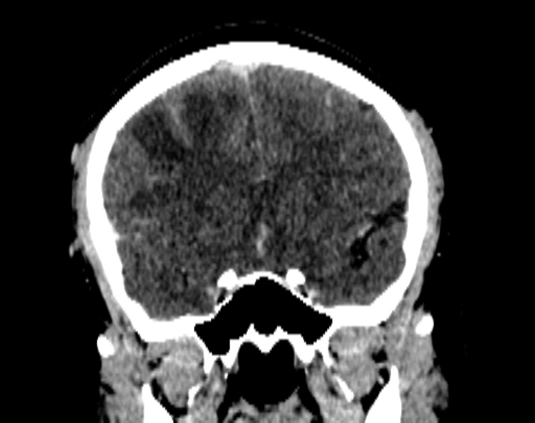 Cerebral venous hemorrhagic infarct from venous sinus thrombosis (Radiopaedia 55433-61883 Coronal C+ delayed 27).jpg