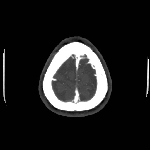 Cerebral venous sinus thrombosis (Radiopaedia 40619-43227 A 211).jpg