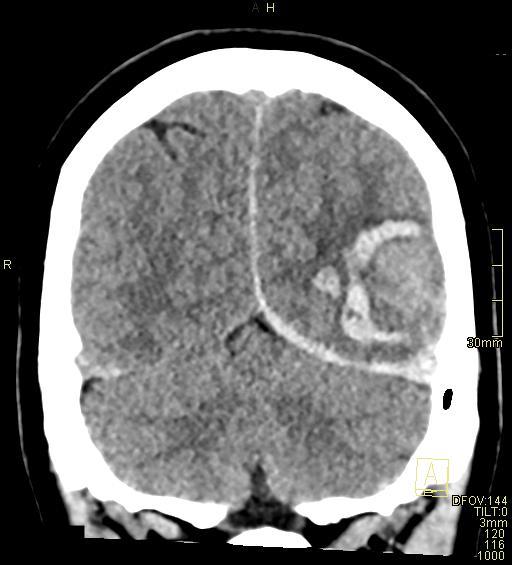 Cerebral venous sinus thrombosis (Radiopaedia 91329-108965 Coronal non-contrast 45).jpg