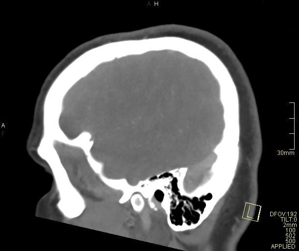 Cerebral venous sinus thrombosis (Radiopaedia 91329-108965 Sagittal venogram 14).jpg