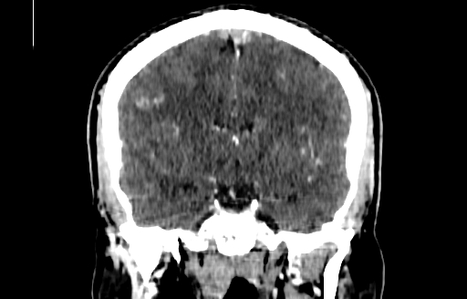 File:Cerebral venous thrombosis (CVT) (Radiopaedia 77524-89685 C 31).jpg