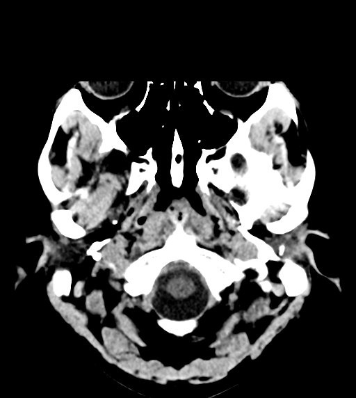 File:Cerebral venous thrombosis (Radiopaedia 38392-40467 Axial non-contrast 3).png