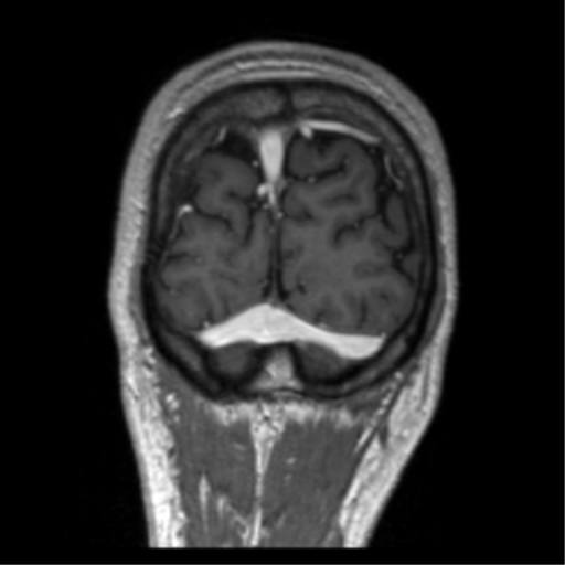 Cerebral venous thrombosis (Radiopaedia 38392-40469 Coronal T1 C+ 10).png