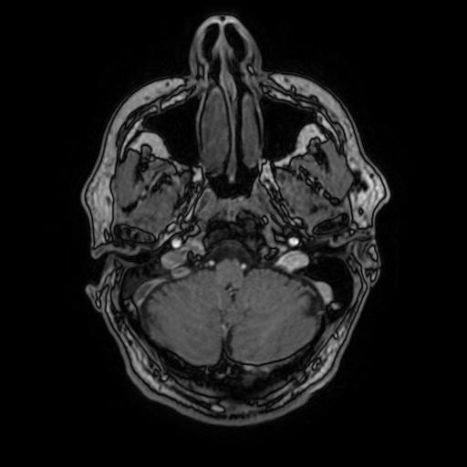 File:Cerebral venous thrombosis with secondary intracranial hypertension (Radiopaedia 89842-106957 Axial T1 C+ 44).jpg