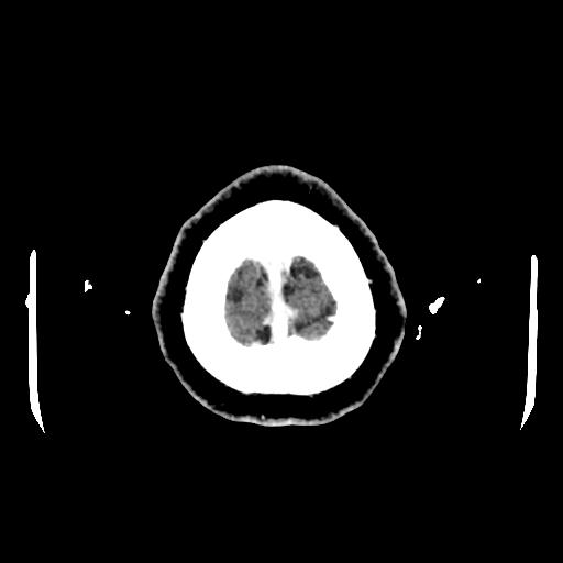 Cerebral venous thrombosis with venous hemorrhagic infarct (Radiopaedia 90354-107660 Axial with contrast 162).jpg
