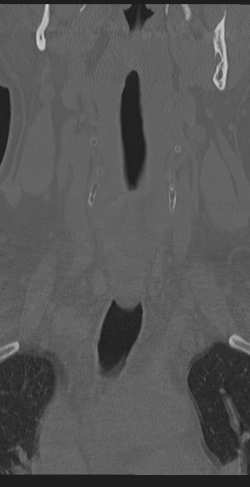 Cervical canal stenosis due to ossification of the posterior longitudinal ligament (Radiopaedia 47260-51823 Coronal bone window 7).png