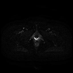 Cervical carcinoma (Radiopaedia 85405-101028 Axial DWI 1).jpg