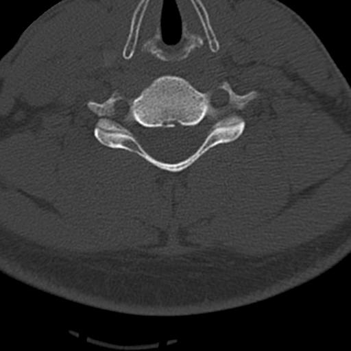 File:Cervical schwannoma (Radiopaedia 57979-64974 Axial bone window 33).png