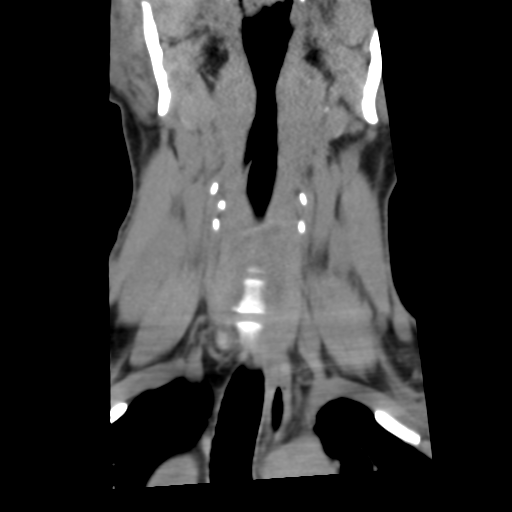 File:Cervical schwannoma (Radiopaedia 57979-64974 Coronal non-contrast 13).png