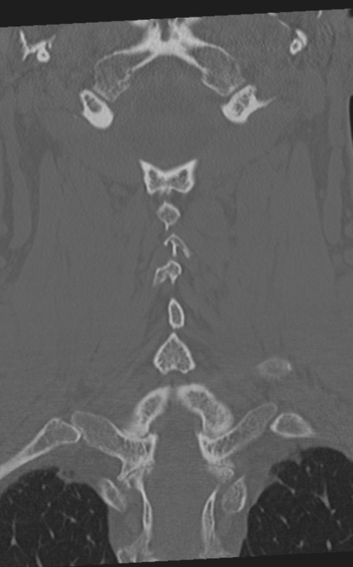 Cervical spine fractures with vertebral artery dissection (Radiopaedia 53296-59268 Coronal bone window 45).png