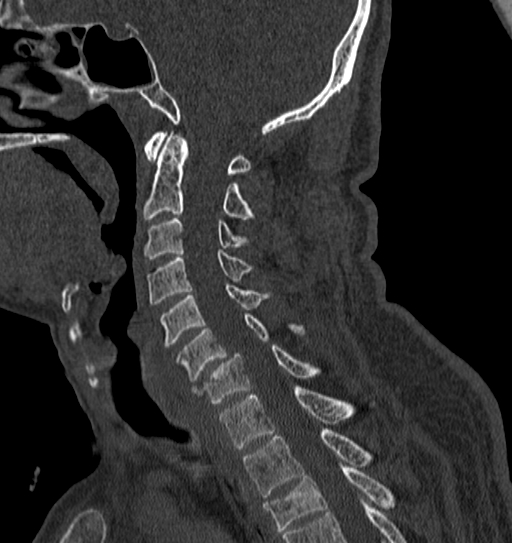 Cervical spine trauma with tear drop fracture and perched facet joint (Radiopaedia 53989-60127 Sagittal bone window 85).jpg