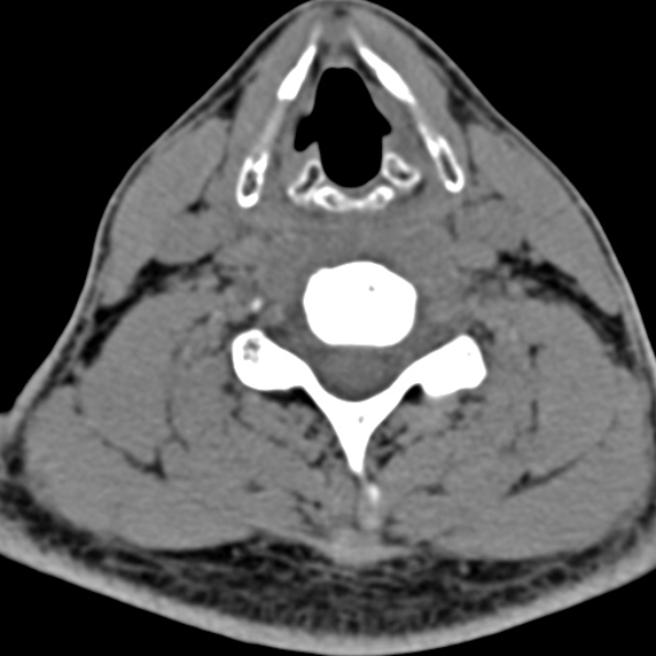 Cervical spondylodiscitis (Radiopaedia 28057-29489 Axial non-contrast 49).jpg