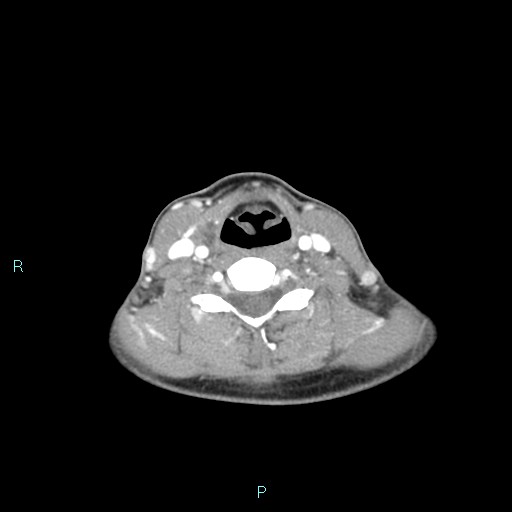 Cervical thymic cyst (Radiopaedia 88632-105335 B 51).jpg