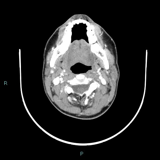 File:Cervical thymic cyst (Radiopaedia 88632-105335 B 81).jpg