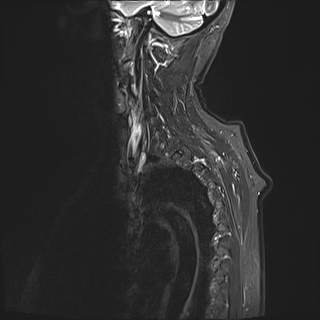 File:Cervical tumor-like myelopathy due to Type V dAVF (Radiopaedia 82461-96604 Sagittal STIR 19).jpg