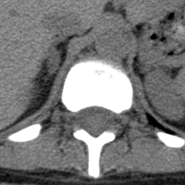 File:Chance fracture (Radiopaedia 36521-38081 Axial non-contrast 58).jpg