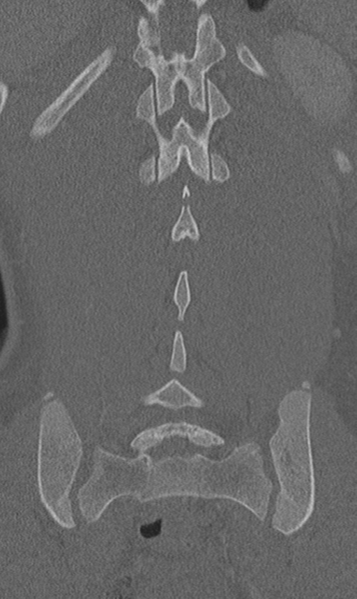 Chance fracture (Radiopaedia 40360-42912 Coronal bone window 53).png