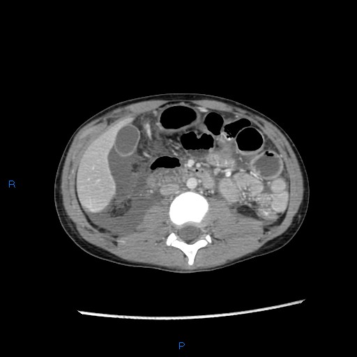 File:Chance fracture with duodenal and pancreatic lacerations (Radiopaedia 43477-46864 A 19).jpg