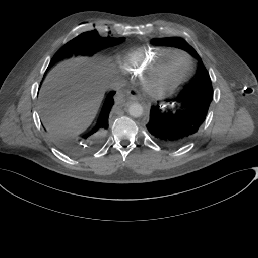 File:Chest multitrauma - aortic injury (Radiopaedia 34708-36147 A 217).png