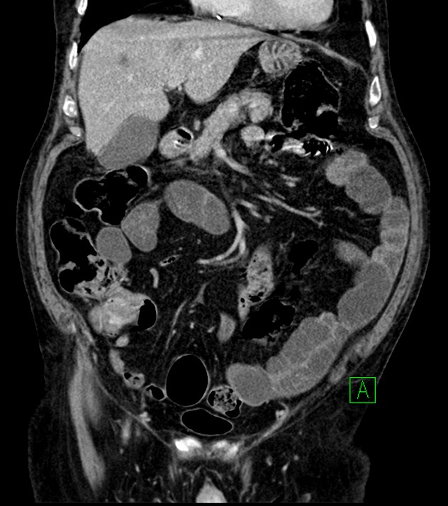 Cholangiocarcinoma with cerebral metastases (Radiopaedia 83519-98629 G 30).jpg