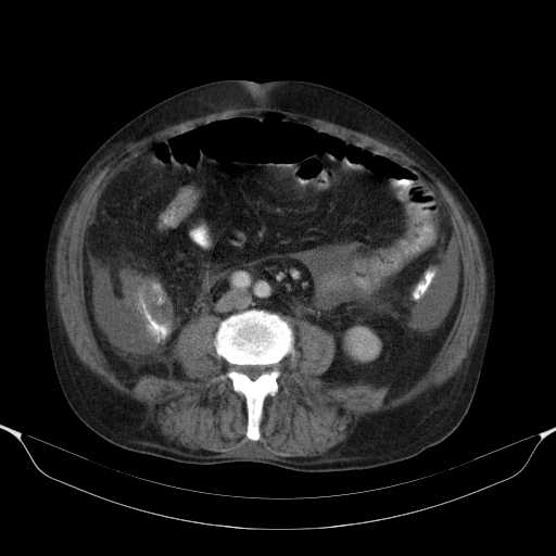 File:Cholangitis and abscess formation in a patient with cholangiocarcinoma (Radiopaedia 21194-21100 A 30).jpg