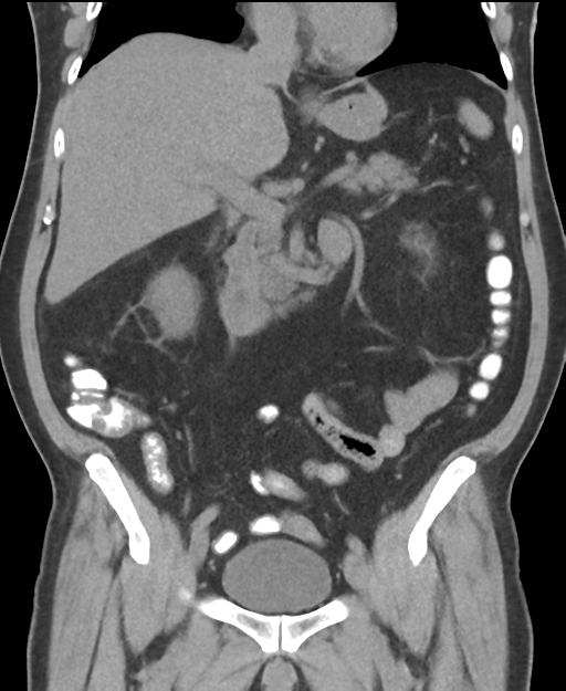 Cholecystitis with focal perforation and hepatic abscess (Radiopaedia 37189-38945 Coronal non-contrast 28).png