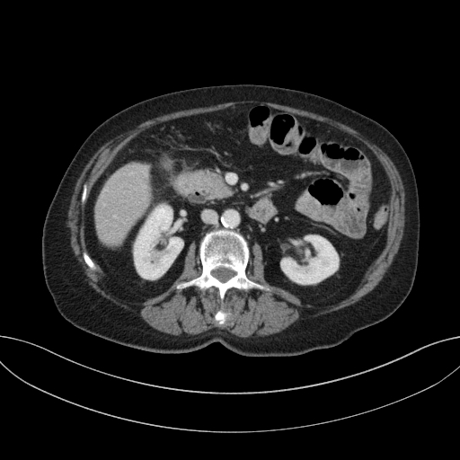 Cholecystoduodenal fistula due to calculous cholecystitis with gallstone migration (Radiopaedia 86875-103077 D 37).jpg