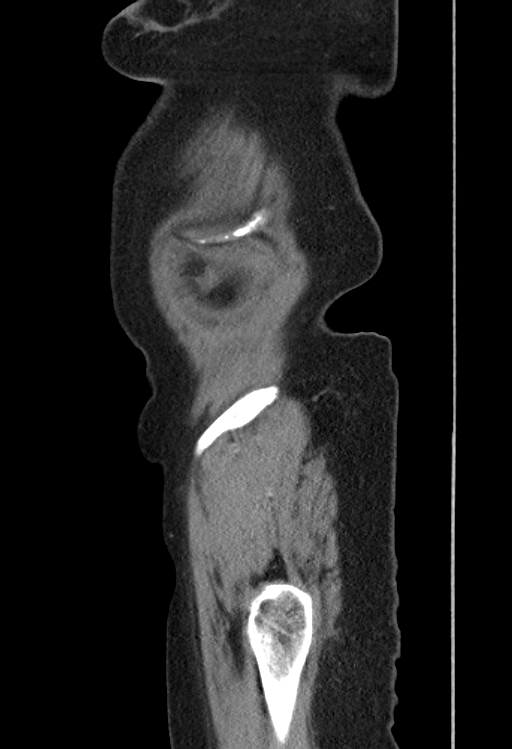 Cholecystoduodenal fistula due to calculous cholecystitis with gallstone migration (Radiopaedia 86875-103077 F 1).jpg