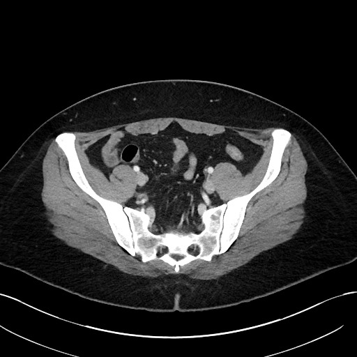 File:Choledocholithiasis after recent cholecystectomy (Radiopaedia 60929-68737 Axial 34).jpg