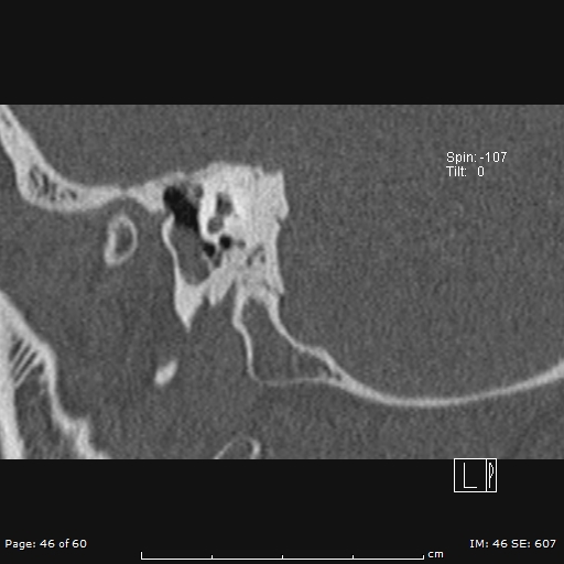 Cholesteatoma - external auditory canal (Radiopaedia 88452-105096 Sagittal bone window 46).jpg