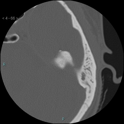 File:Cholesterol granuloma of the petrous apex (Radiopaedia 64358-73141 Axial bone window 32).jpg