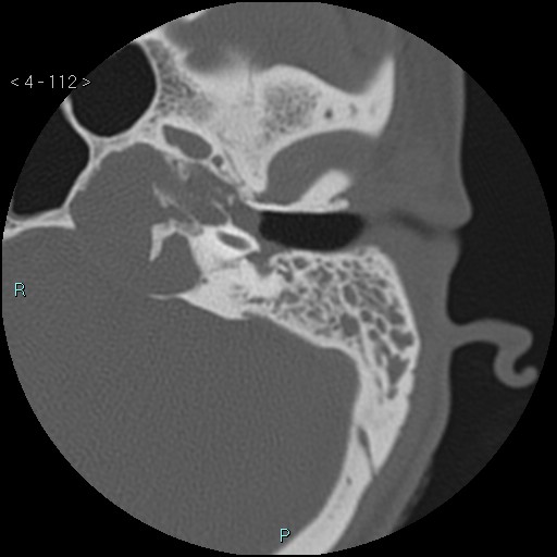 File:Cholesterol granuloma of the petrous apex (Radiopaedia 64358-73141 Axial bone window 54).jpg