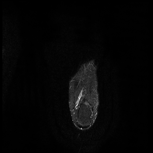 File:Chondroblastoma - midfoot (Radiopaedia 64831-73765 Long axis T2 fat sat 4).jpg