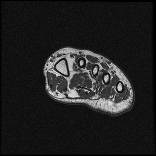 File:Chondroblastoma - midfoot (Radiopaedia 64831-73765 Short axis T1 23).jpg