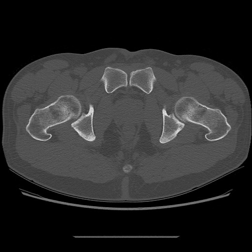 File:Chondrosarcoma of iliac wing (Radiopaedia 63861-72599 Axial bone window 112).jpg