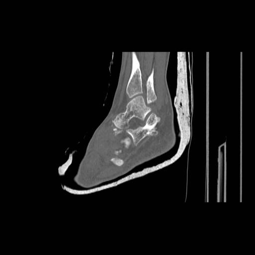 File:Chopart fracture (Radiopaedia 12386-12650 Sagittal bone window 3).jpg
