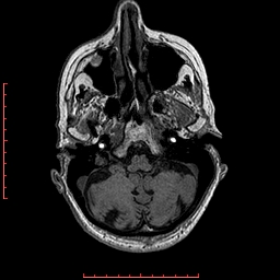 Choroid plexus xanthogranuloma (Radiopaedia 67843-77270 Axial T1 131).jpg