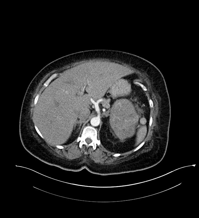 Chromophobe renal cell carcinoma (Radiopaedia 84239-99519 B 29).jpg