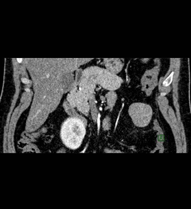Chromophobe renal cell carcinoma (Radiopaedia 84286-99573 E 15).jpg