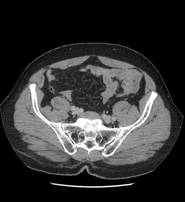 Chromophobe renal cell carcinoma (Radiopaedia 86879-103083 C 116).jpg