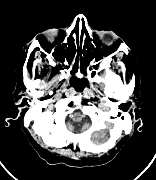 File:Chronic bilateral subdural hygroma (Radiopaedia 85801-101623 Axial non-contrast 52).jpg