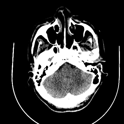 Chronic invasive fungal sinusitis (Radiopaedia 91563-109286 Axial non-contrast 14).jpg
