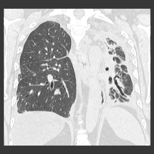 File:Chronic lung allograft dysfunction - restrictive form (Radiopaedia 60595-68316 Coronal lung window 67).jpg