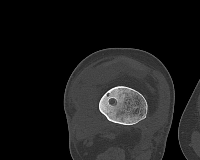 Chronic ostemyelitis of the femur with long sinus tract (Radiopaedia 74947-85982 Axial bone window 190).jpg