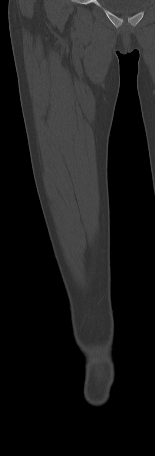 Chronic ostemyelitis of the femur with long sinus tract (Radiopaedia 74947-85982 Coronal bone window 23).jpg