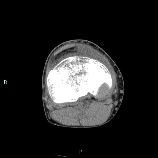 Chronic osteomyelitis (with Brodie abscess) (Radiopaedia 76405-88111 A 104).jpg