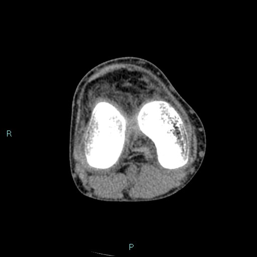 Chronic osteomyelitis (with Brodie abscess) (Radiopaedia 76405-88111 A 118).jpg