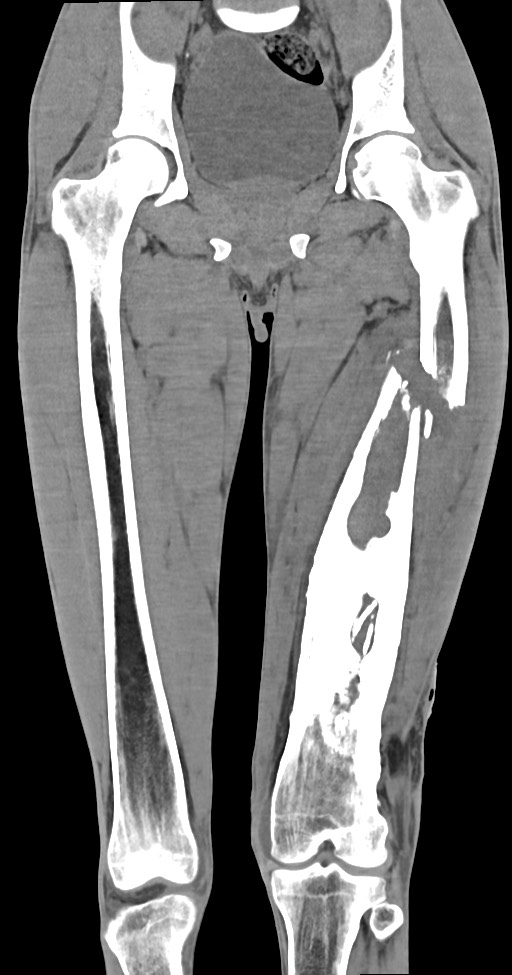 Chronic osteomyelitis (with sequestrum) (Radiopaedia 74813-85822 E 27).jpg