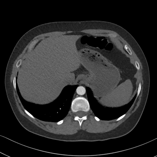 Chronic pulmonary embolus (Radiopaedia 39129-41341 Axial C+ CTPA 89).png