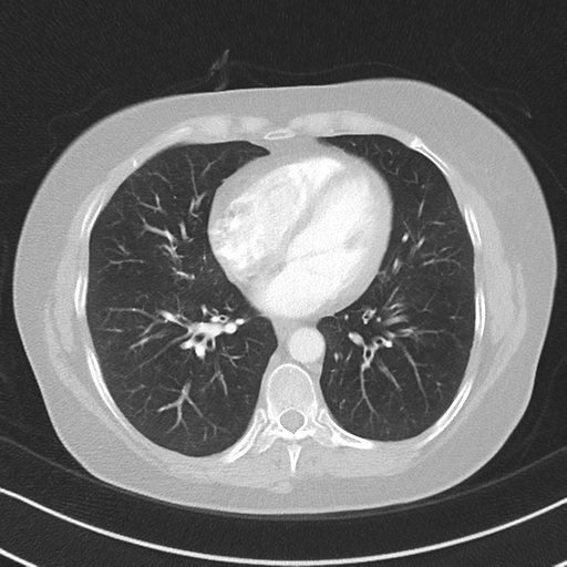 Chronic pulmonary embolus (Radiopaedia 39129-41341 Axial lung window 40).png